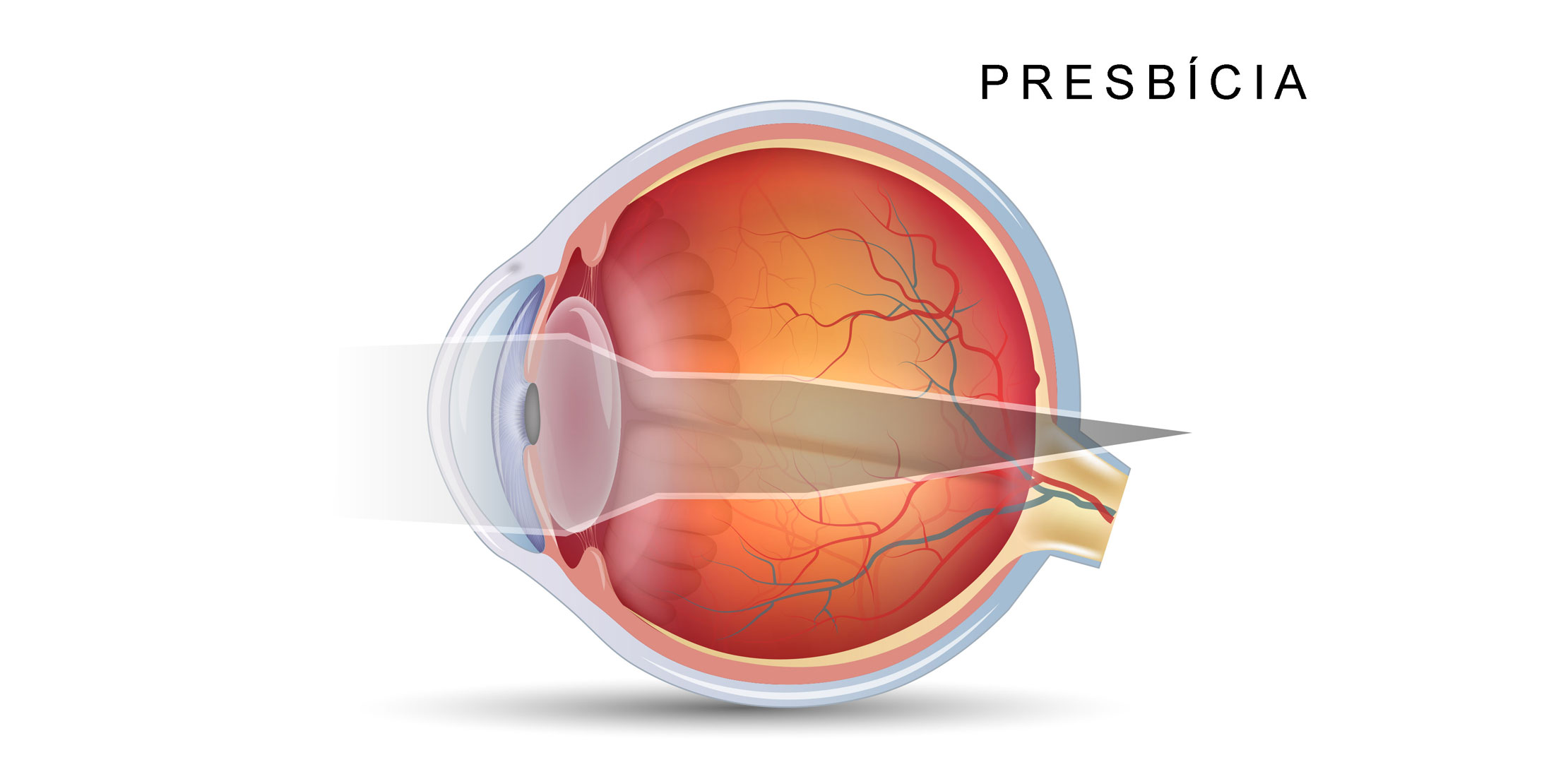 hipermetropia e astigmatismo presbicia