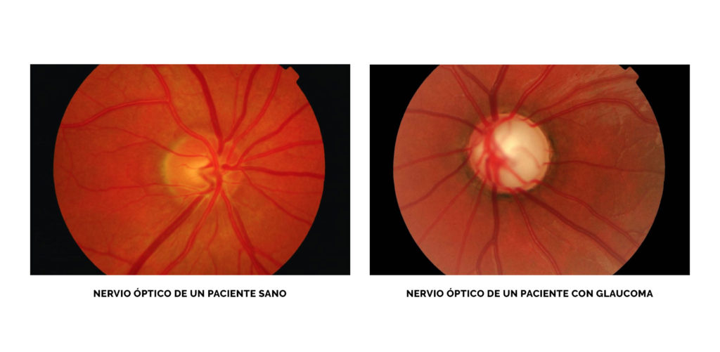 Glaucoma – Veja Moreno Clínica Oftalmológica